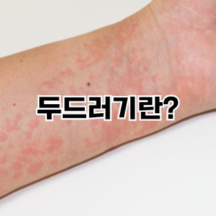 두드러기란?
