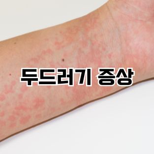 두드러기 증상