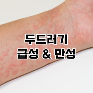 두드러기 급성과 만성