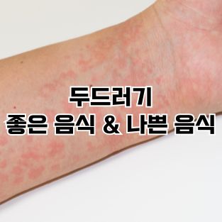 두드러기 좋은음식과 안좋은음식